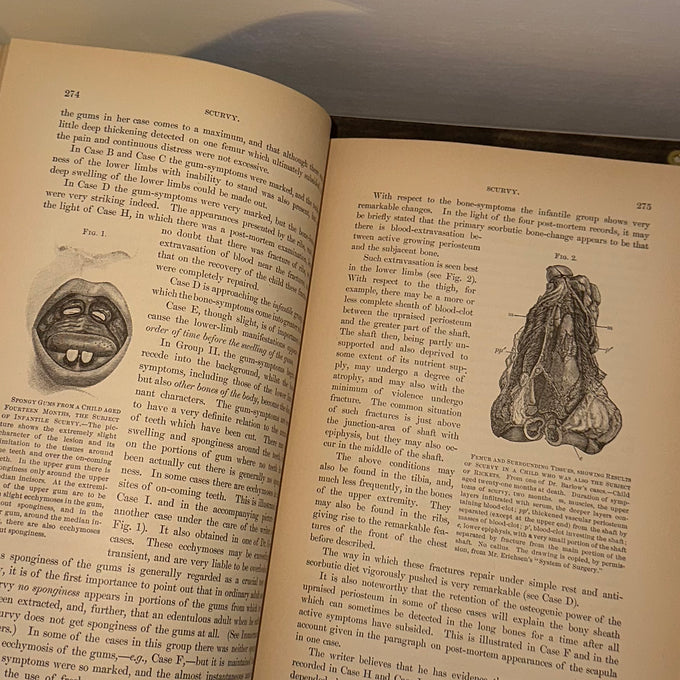 Cyclopædia of the Diseases of Children – Vol. II (John M. Keating, Antique Medic