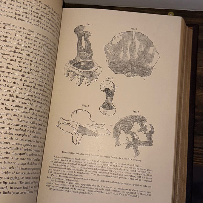 Cyclopædia of the Diseases of Children – Vol. II (John M. Keating, Antique Medic